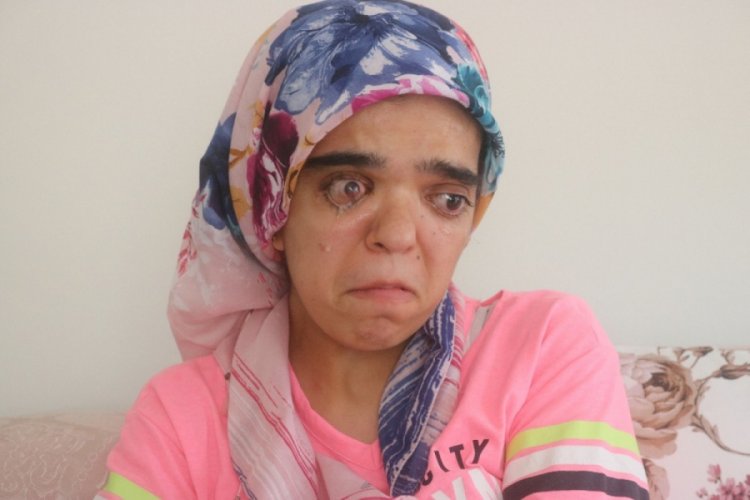 21 yaşındaki gen&ccedil; kız, g&uuml;zelliğine kavuşmak i&ccedil;in yardım bekliyor