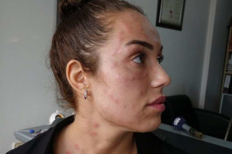 'Gen&ccedil;lik aşısı' adı altında cildine işlem yapılan kadından su&ccedil; duyurusu