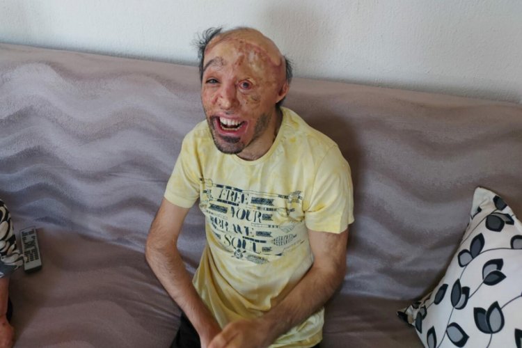 İlk ameliyatı olup iyileşti, sıradaki operasyonları bekliyor