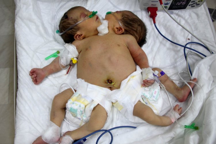 Tek kalple hayata tutunan 'siyam ikizleri' tedavi altına alındı