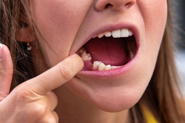 Corona virüs ani ve acısız diş kaybına neden olabilir
