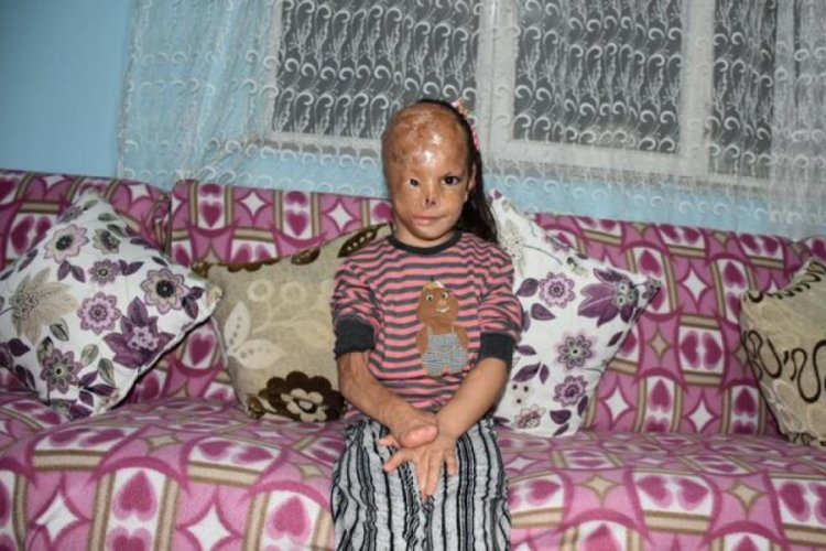 Bebekken yüzü yanan 5 yaşındaki Dilara ameliyat olmak için yardım bekliyor