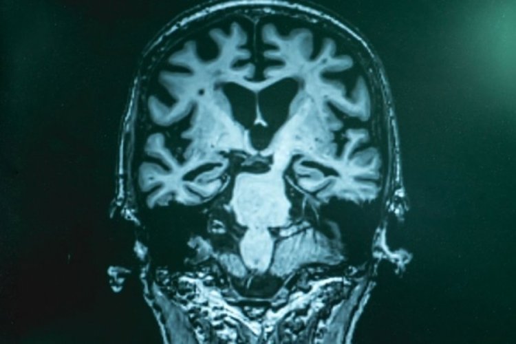 Basit bir kan testiyle Alzheimer teşhisi yapılabilecek