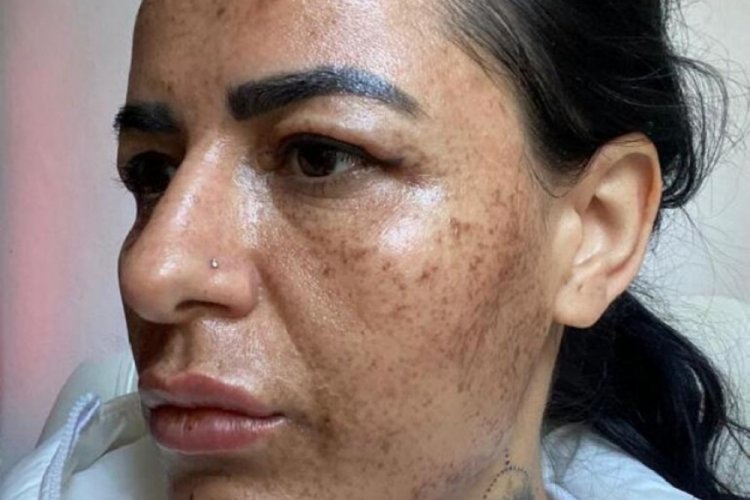 G&uuml;zellik merkezine gitti, suratında yanıklar oluştu