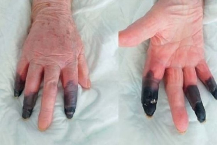 Koronavir&uuml;s hastası kangren oldu, parmakları kesildi