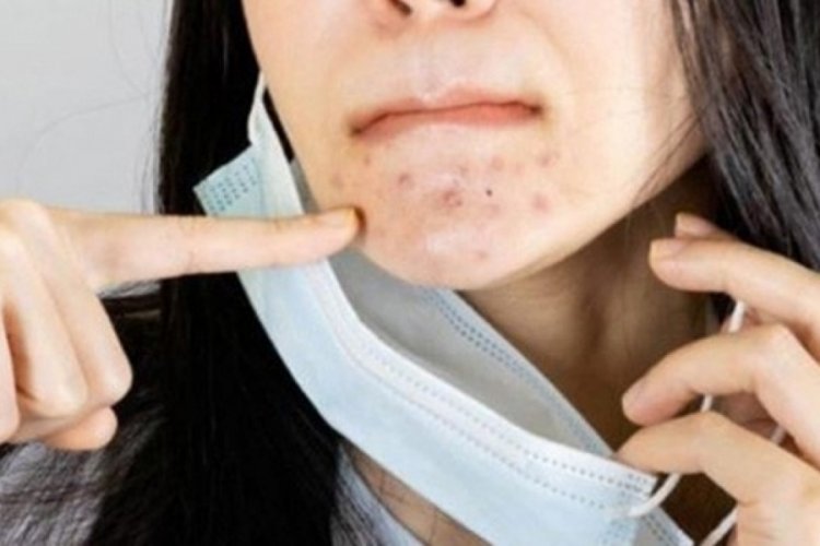 Maske sonrası artan cilt problemlerine &ouml;nlem de &ccedil;&ouml;z&uuml;m de su