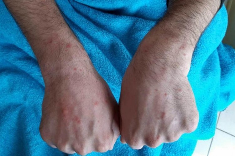 Covid-19'un az bilinen yan etkisi: Ciltte d&ouml;k&uuml;nt&uuml; ve kaşıntı