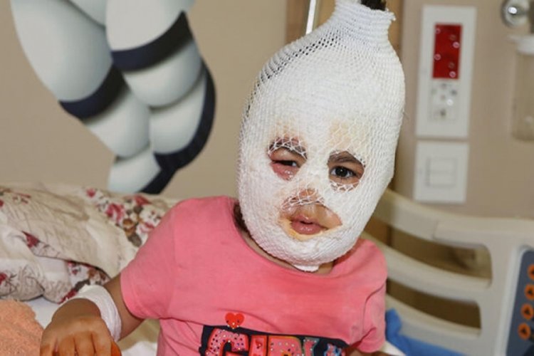 Minik Ayfer sıcak suyla oynarken kendisini yaktı