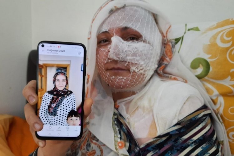 Eşinin kızgın yağ ile yaktığı kadın: &Ouml;lmek istemiyorum