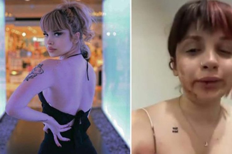 Tayt giydiği için erkek arkadaşının darbettiği kız, dehşeti sosyal medyadan paylaştı