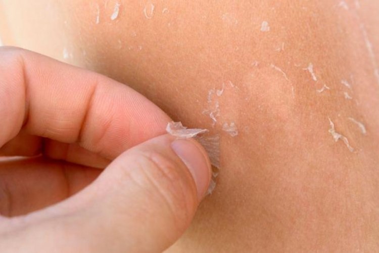 G&uuml;neş yanığından sonra soyulan cilt nasıl iyileşir?