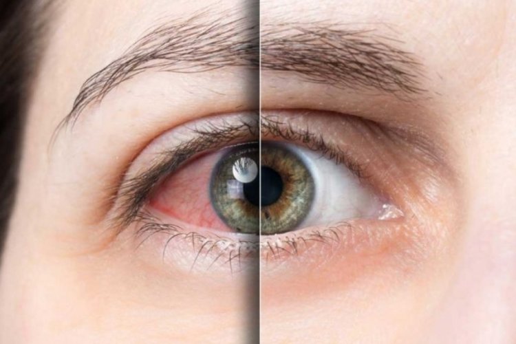 G&ouml;zde oluşan retina yırtığına dikkat! (&Ouml;ZEL HABER)