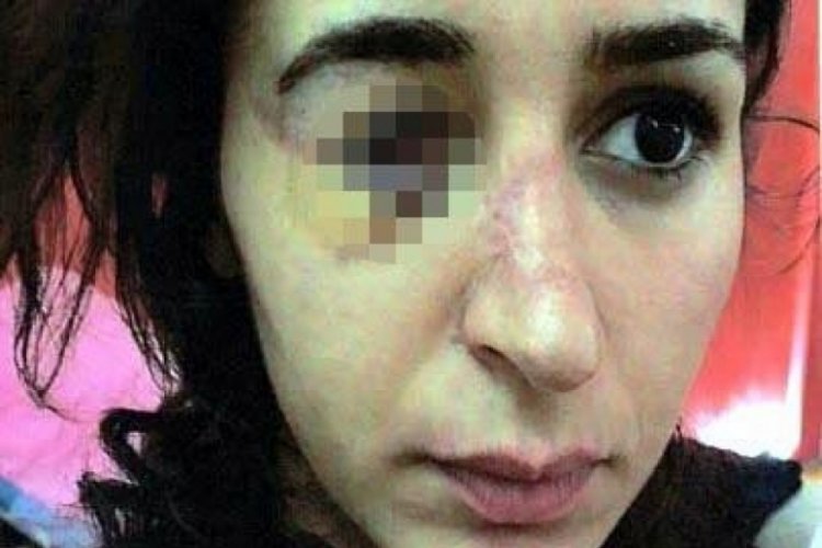 Tuğçe'nin hukuk savaşı: 23 yaş büyük eşi yüzünü parçaladı