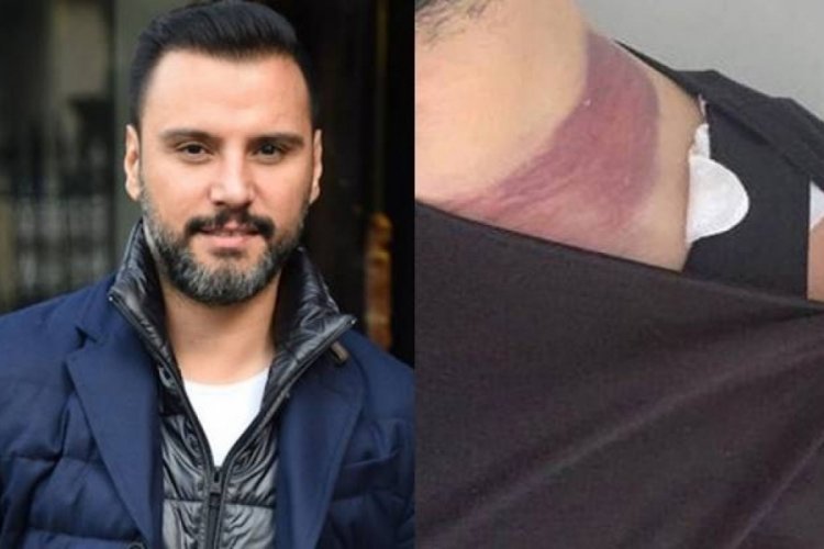 Alişan'ın yağ aldırma davasında karar &ccedil;ıktı
