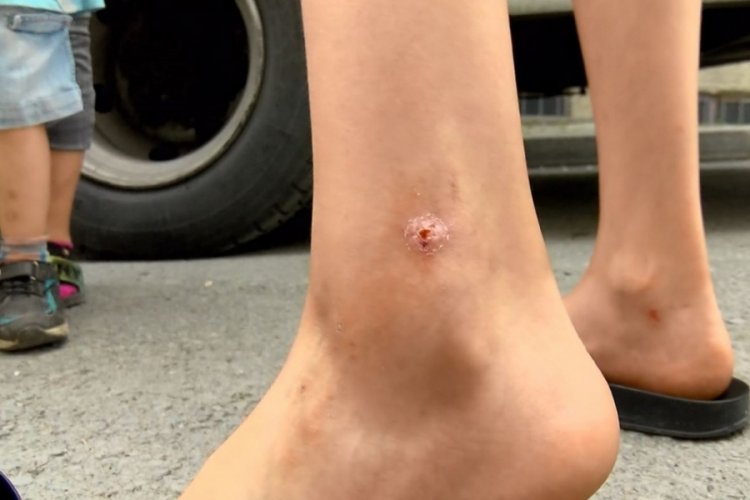 Sivrisineklerin soktuğu &ccedil;ocuklarda yaralar oluştu!