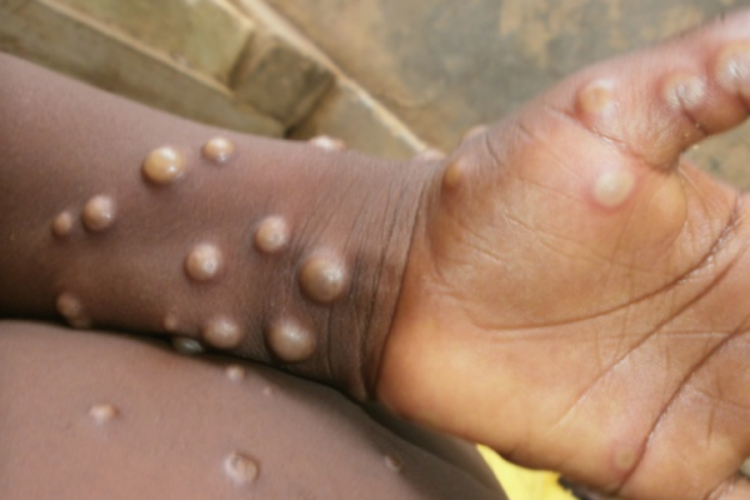 ABD'de Monkeypox alarmı! Uzmanlar virüsün belirtilerini açıkladı
