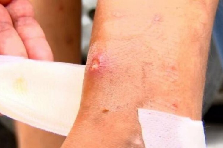 Asya Kaplan Sivrisineği alarmı! Bursa dahil 13 ilde g&ouml;r&uuml;l&uuml;yor