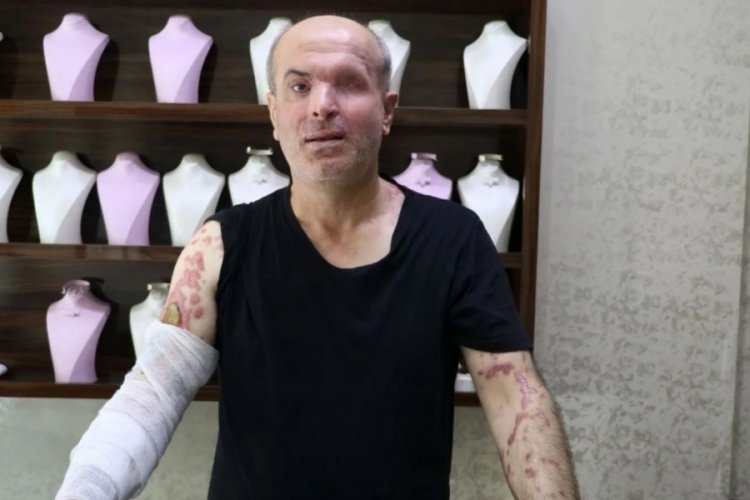 İzmir'de kezzaplı saldırıya uğrayan kuyumcu sol g&ouml;z&uuml;n&uuml; kaybetti