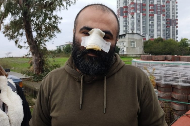 Samsun'da tasmasız dolaştırılan pitbull, iş insanının burnunu kopardı