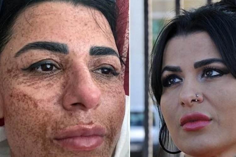 Y&uuml;z yakan lazer uygulamasına şaşırtan ceza
