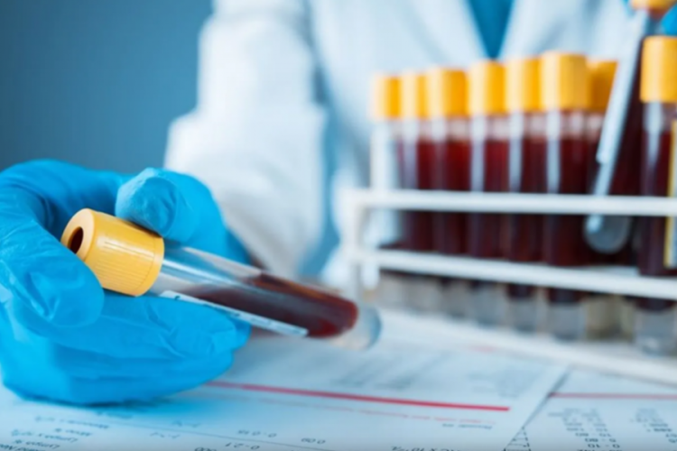 Kan testi ile akciğer kanseri teşhisi m&uuml;mk&uuml;n m&uuml;?