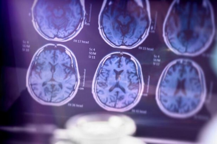 AB, Alzheimer tedavisi i&ccedil;in geliştirilen ilaca onay vermedi