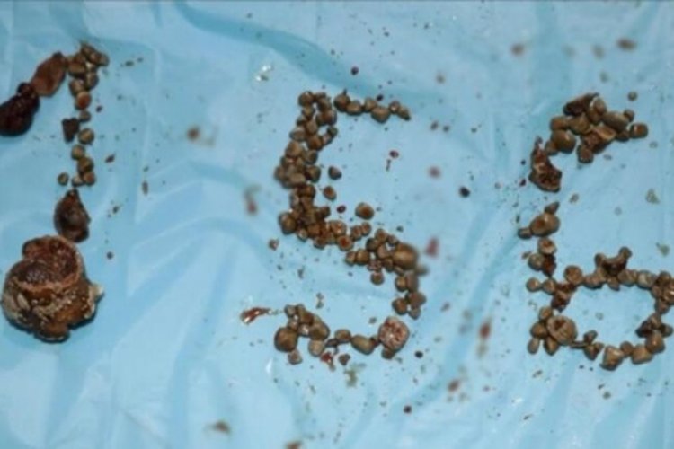 Bu bir rekor! B&ouml;breğinden tam 156 tane taş &ccedil;ıktı