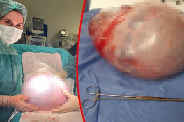 Karın şişliği sandı, 9 kiloluk t&uuml;m&ouml;r &ccedil;ıktı