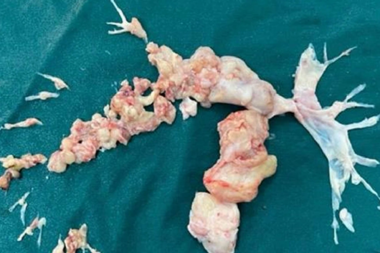 Koronavir&uuml;se bağlı pıhtı sanıldı, duruma doktorları bile şaşırttı!