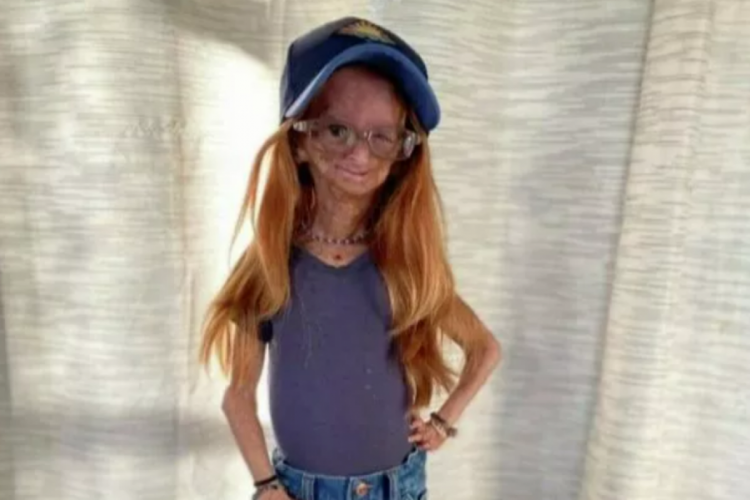 'Benjamin Button' hastalığıyla m&uuml;cadele eden Youtuber, 15 yaşında hayatını kaybetti