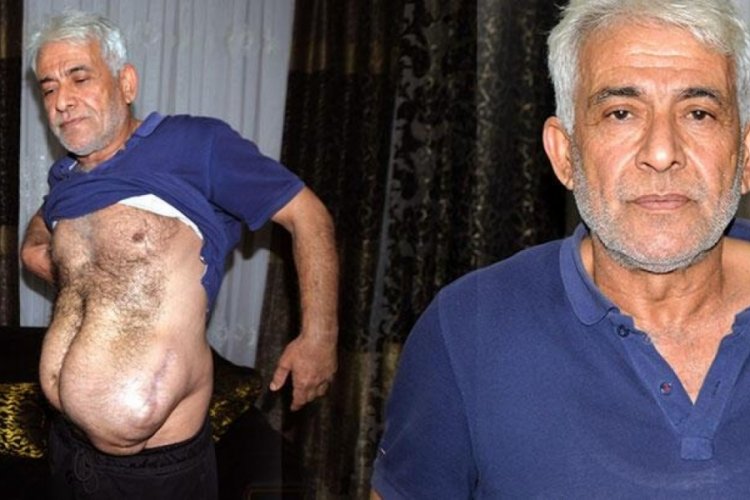 Ayaklarından ameliyat oldu, karnı şişmeye başladı!