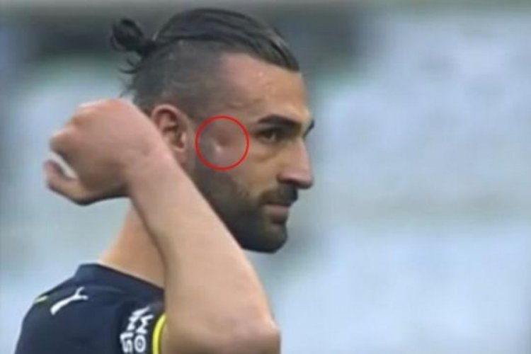 Fenerbah&ccedil;eli futbolcu Serdar Dursun'un elmacık kemiği &ccedil;&ouml;kt&uuml;