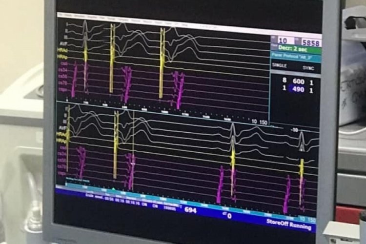 KSB&Uuml; Evliya &Ccedil;elebi Eğitim ve Araştırma Hastanesinde "Kalp Ritim Bozukluklarına" son