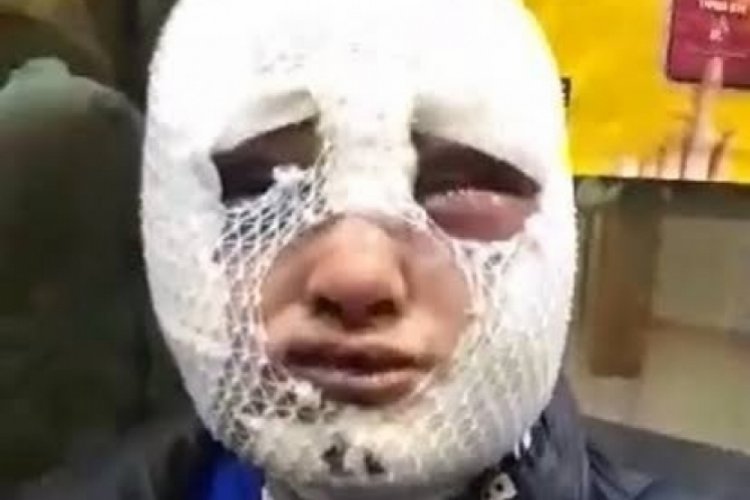 Kız arkadaşının y&uuml;z&uuml;ne kızgın yağ d&ouml;ken zanlıya yeniden yakalama kararı