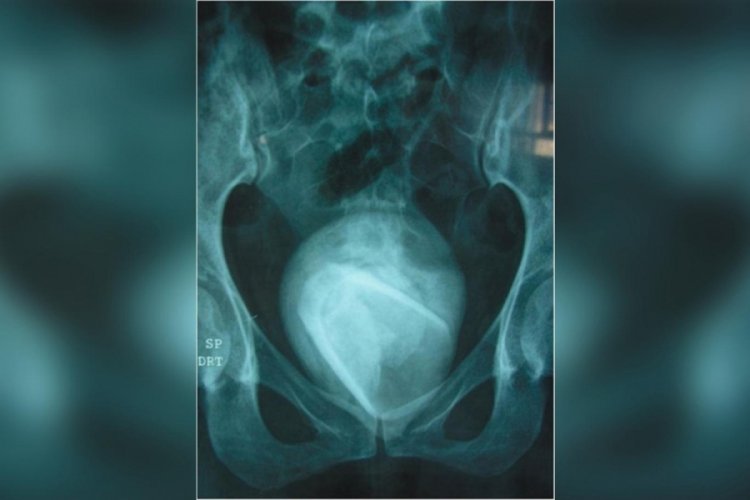 Cinsel organından 8 cm uzunluğunda bardak &ccedil;ıktı
