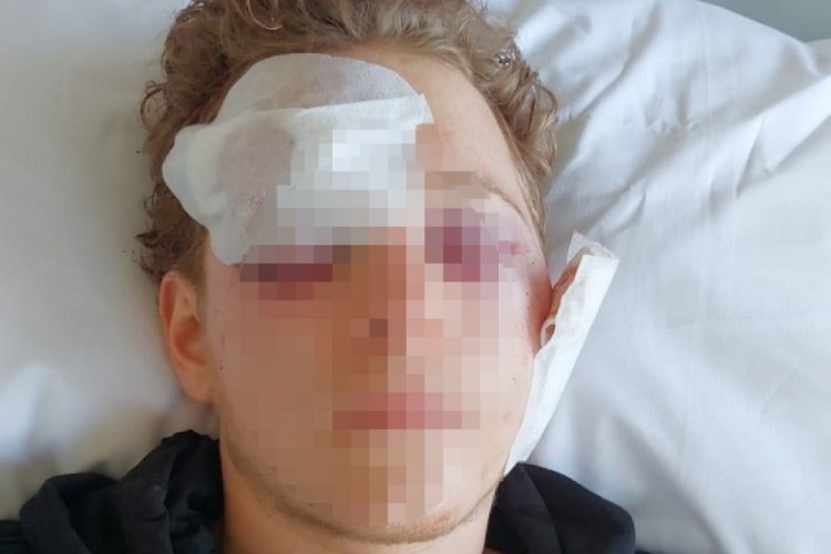 Balıkesir'de arkadaşının şakağından vurduğu Alp, g&ouml;zlerini kaybetti