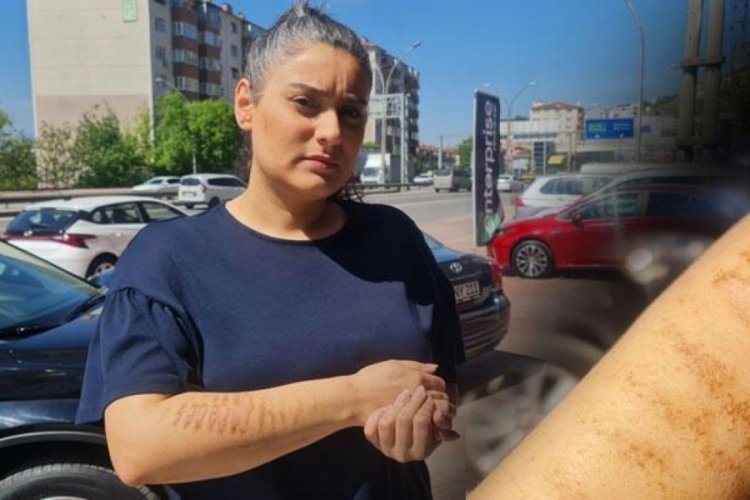 Kocaeli'de epilasyon kollarını yaktı