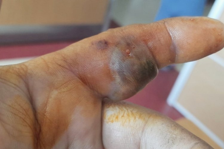 Bursa'da bir adam yılanla hastaneye koştu