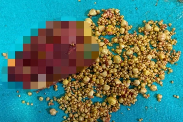 Safra kesesinden 1284 adet taş &ccedil;ıkarıldı