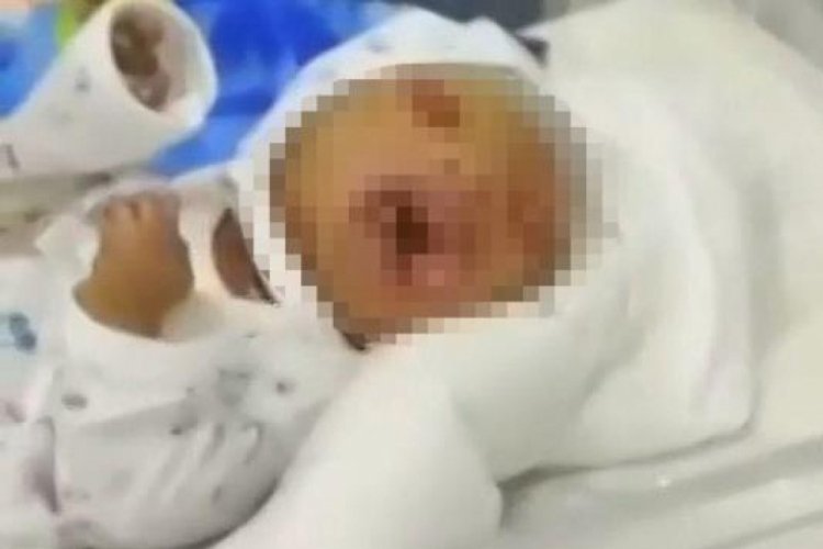 Kalıtımsal hastalıkla doğan bebek hastaneyi alarma ge&ccedil;irdi