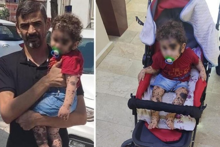 Hatay'da doğuştan hasta olan bebek tedavi ediliyor
