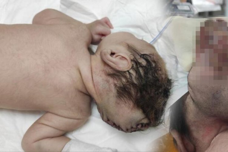 Beyni dışarıda doğmuştu, ameliyat eden doktor konuştu! 'İki sebebi var'