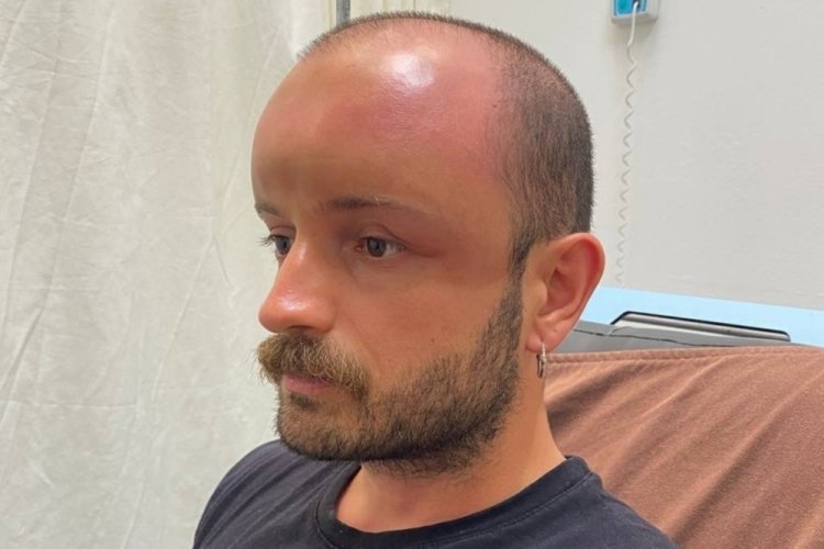 Zonguldak'ta denize girdi... Kafasında şişlik oluştu