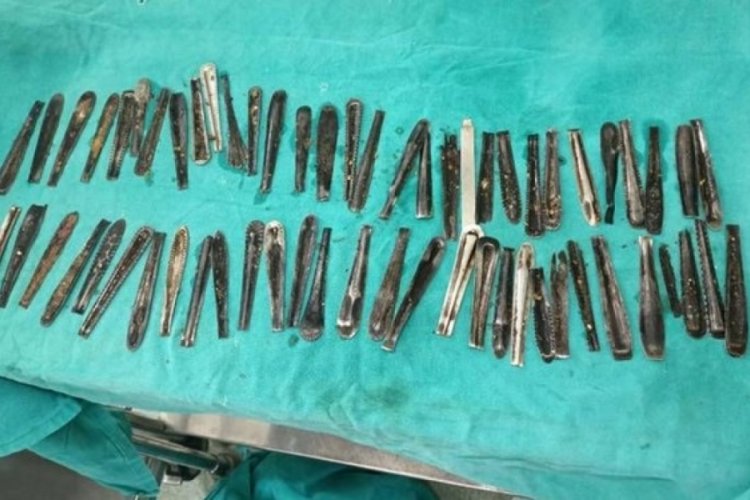 Hindistan'da bir kişinin karın ağrısıyla gittiği hastanede ameliyat oldu