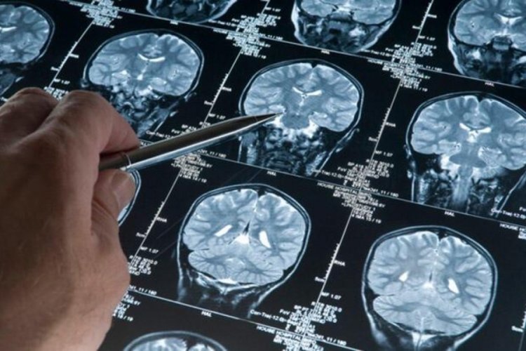Alzheimer'ın beyindeki tahribatını yavaşlatan ila&ccedil; geliştirildi