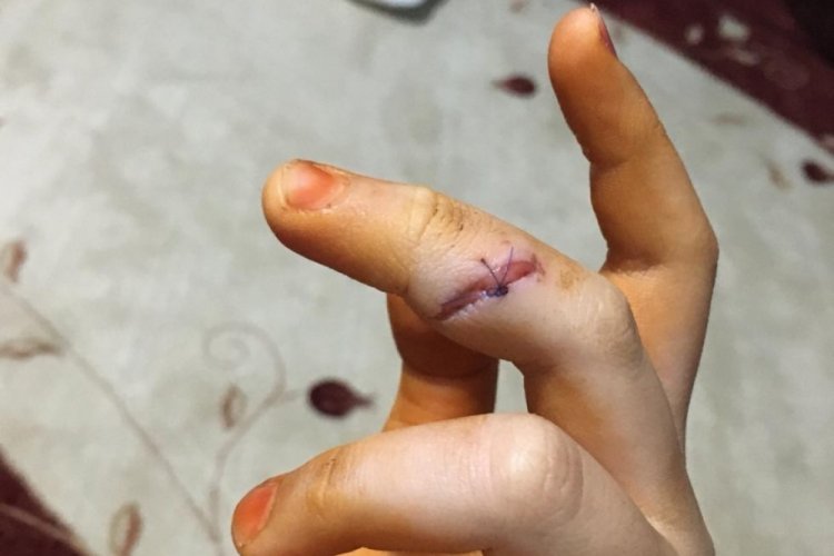 Ankara'da k&ouml;peklerin saldırdığı &ccedil;ocuk yaralandı