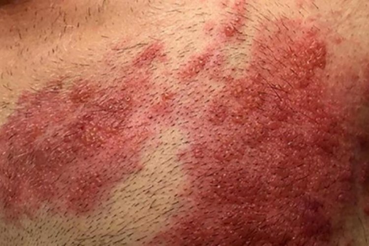 Son 10 yılda g&ouml;r&uuml;lenden daha fazla! Zona vakalarını yeniden hatırlattı
