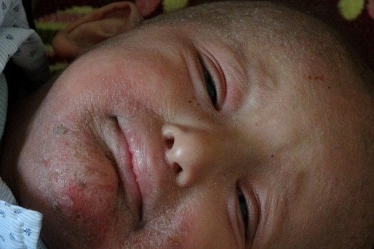 Mardin'de 'Balık pulu' hastalığıyla yaşayan &ccedil;ocuğun hayatı kabusa d&ouml;nd&uuml;