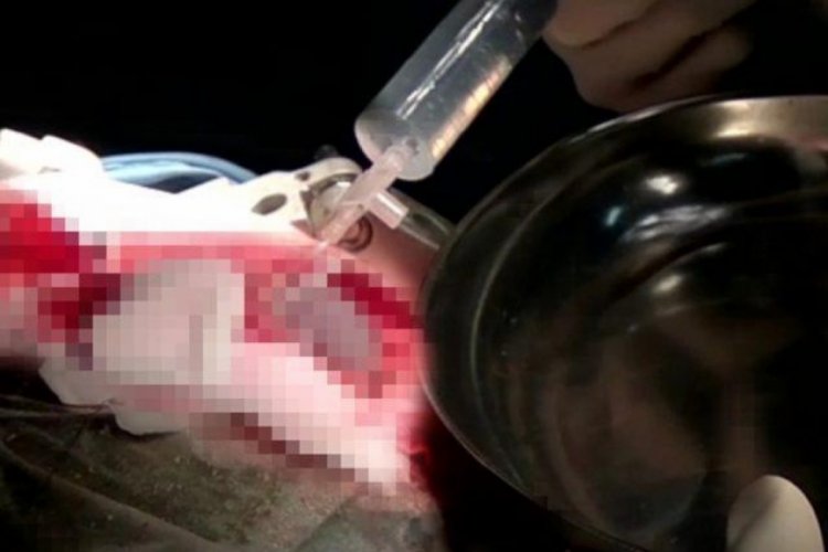 Baş ağrısıyla gittiği hastanede beyninden t&uuml;m&ouml;r &ccedil;ıkartıldı