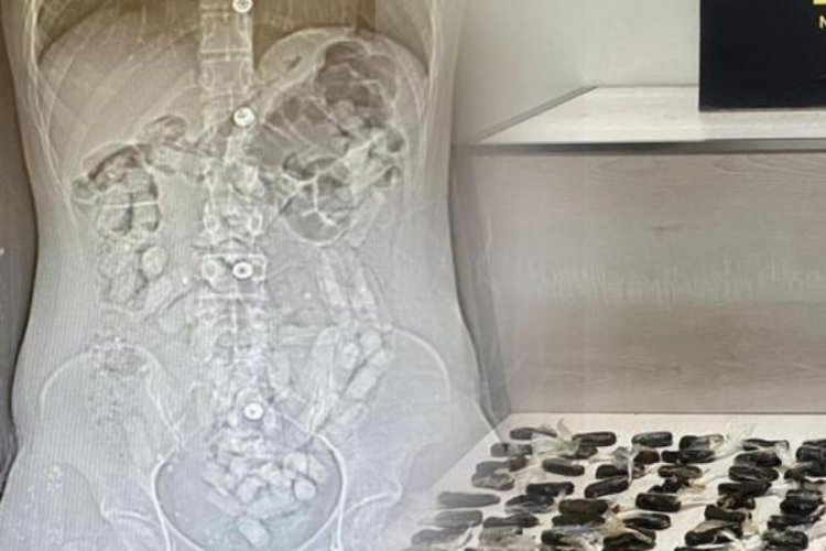 İranlı 2 kadının midelerinden 693,3 gram Afyon sakızı &ccedil;ıktı